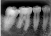 cirúrgicos de alavancas durante exodontias de dentes vizinhos ou, ainda, batidas do laringoscópio durante procedimentos anestésicos gerais.