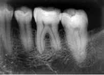 Nas reabsorções dentárias atribuídas a uma provável causa sistêmica, é necessário encaminhar o paciente ao endocrinologista 9,10,16, pois