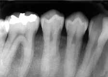 predisposição individual nas reabsorções radiculares em Ortodontia, quase sempre são
