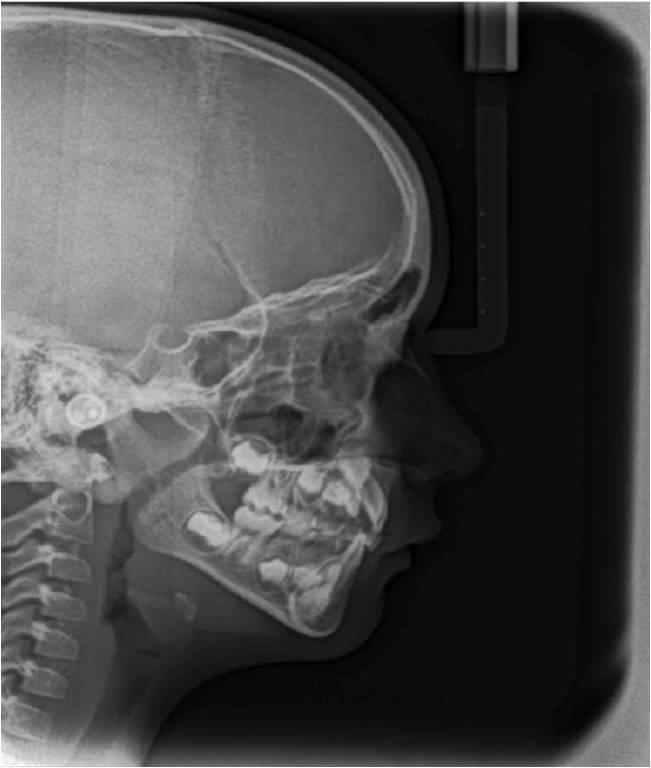 32 Figura 6 Radiografia cefalométrica lateral de um paciente que possui o espaço nasofaringeo estreito. - Fonte: CIOF. O Programa Radiocef Studio 2.
