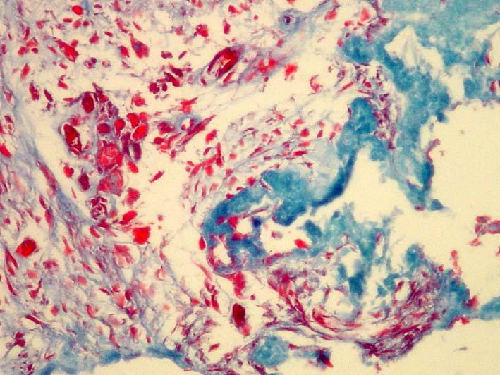 103 * FIGURA 24b Grupo Emdogain - 30 dias: Detalhe dos fibroblastos (*) e vasos sanguíneos congestos ( ). (Tricômico de Masson -200x).