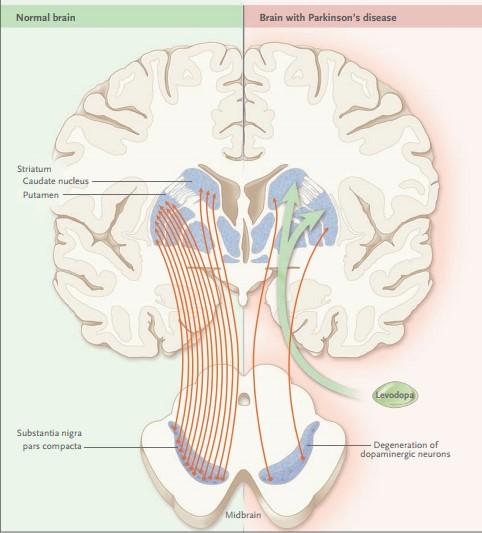 Administração de fármacos em caso de disfagia associada à doença de Parkinson Figura 3- Representação neurodegenerativa num cérebro sem e com doença de Parkinson (Adaptado de LeWitt, 2008).