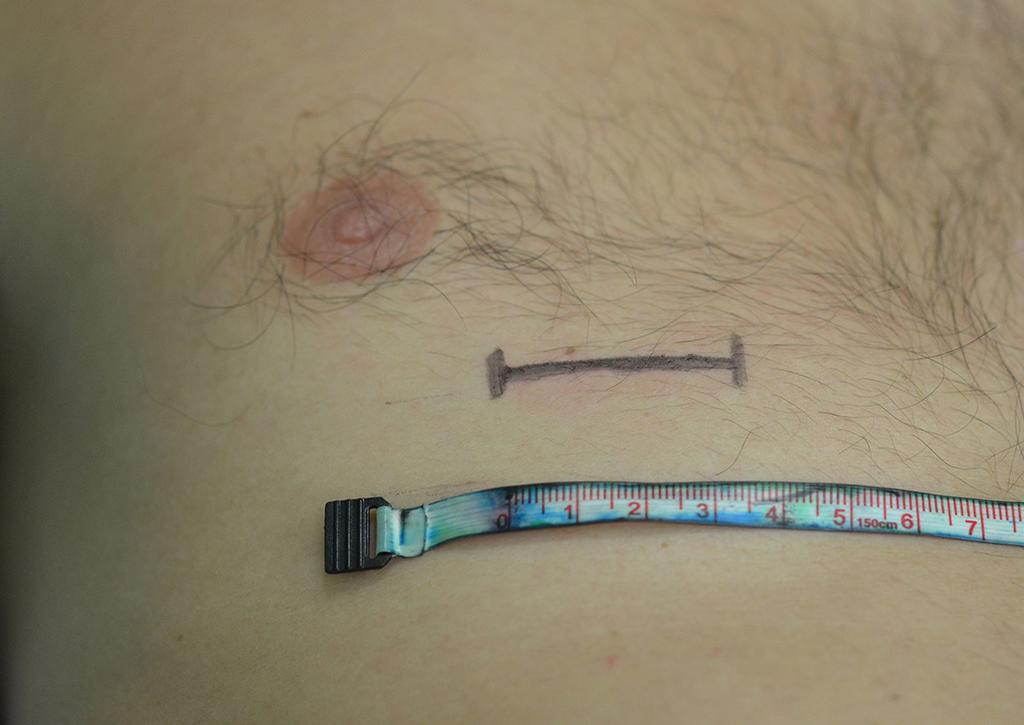 Figura 4. Rinoplastia reparadora: foto basal pré-operatória. Figura 5.