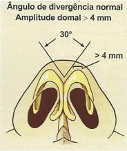 42 FIGURA17: Diagrama mostrando as variações possíveis dos tipos de ponta nasal tendo como variáveis o ângulo de divergência domal e amplitude domal segundo Gunter. Fonte: GUNTER, JP; ROHRICH, R.