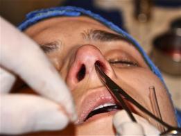 assimetrias no lóbulo nasal após o aperto da sutura e confecção do nó (Figura 39, 40 e 41). FIGURA 39 - Trans-operatório.