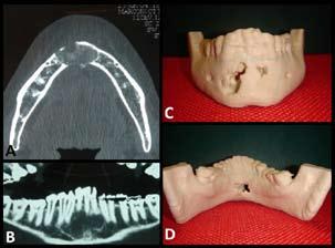 PAIVA et al. O FO ocorre mais na região posterior de mandíbula 3,6,7-12, tem predileção pelo sexo feminino 4,6,12-18 e maior incidência na terceira e quarta décadas de vida 10,12,13.