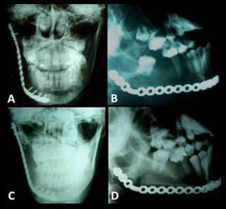 PAIVA et al. induzido por trauma 1, como a realização prévia de uma exodontia e a periodontite 2,6, ou simplesmente estaria ligada a uma perturbação na maturação óssea de origem congênita 7,24.