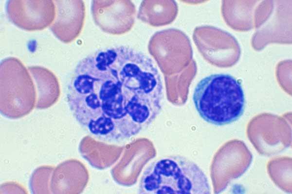 Polilobocitos (+ 5 lóbulos) deficiência de matéria-prima para síntese de DNA anemias