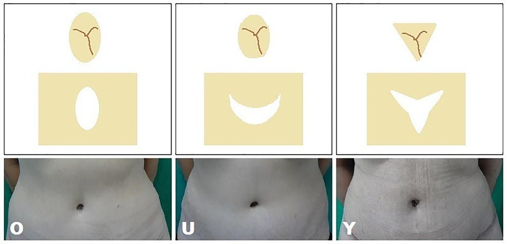 Figure 2. The omphaloplasty techniques used in this study.