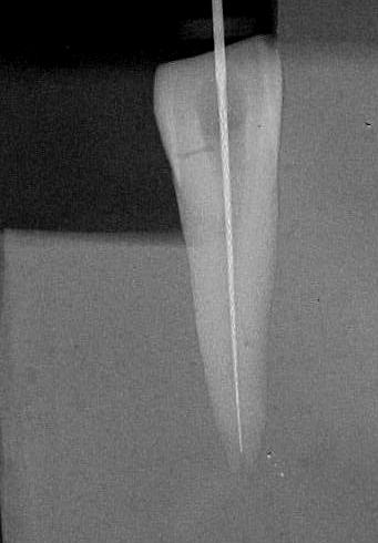 Radiografias pré-operatórias Antes da instrumentação os dentes foram radiografados com uma lima tipo K n 15 no comprimento real de trabalho (CRT) inseridos nas duas matrizes e estas