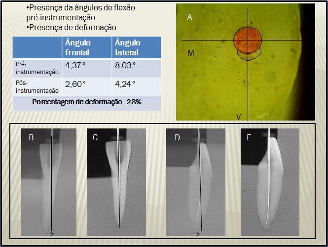 Figura 9 Amostra que apresentou variação dos ângulos de flexão e deformação do batente apical após a instrumentação. Em A.