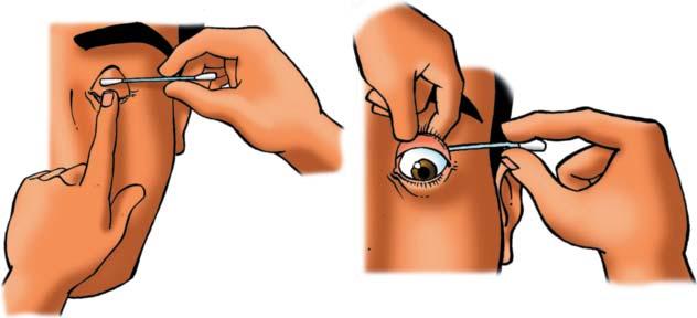 Lesións oculares Normas de actuación O que se debe facer Non utilice calquera tipo de colirio sobre o ollo. Non fregue o ollo. Non manipule sobre o ollo para intentar sacar o corpo estraño.