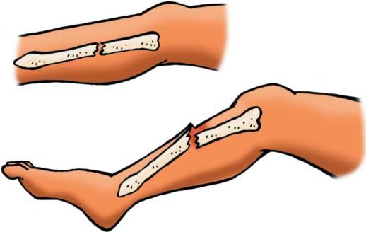 Traumatismos Normas de actuación Fracturas Consiste na rotura dun óso, que pode ter os fragmentos desviados ou non. Se a pel permanece intacta, teremos unha fractura pechada.