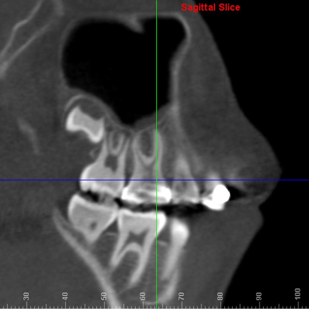 33 e coronal) eram mostrados na mesma tela. Na vista sagital, a linha de referência vertical era posicionada no centro (no sentido mesiodistal) da raiz em que as medidas seriam feitas (Figura 3).