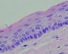 Figura 1 HE (40x), Limitante epitelial fino, circundado por cápsula de tecido conjuntivo.