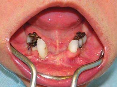 INTRODUÇÃO Os implantes dentários têm sido amplamente utilizados na reabilitação de pacientes edêntulos mandibulares, devolvendo a função e aumentando o confor to se comparados ao uso de próteses