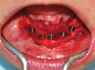 Um total de 102 implantes foi utilizado nas reabilitações e tiveram como antagonistas superiores dentes naturais, pr óteses fi xas e totais com um acompanhamento clínico e radiográfi co variando