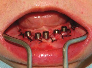 Exemplificando então um caso do início ao fi m, procedem-se com a extração prévia dos dentes remanescentes inferior es env olvidos periodontalmente, seguindo-se o processo semelhante às técnicas