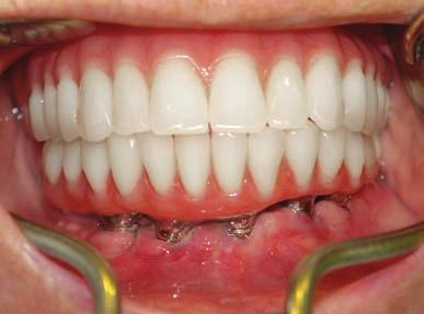 imediata, minimizando a possibilidade de pr oblemas com ar ticulação dos dentes ou adaptação de barra junto