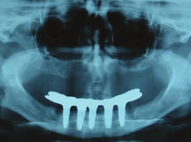 Prova da barra e montagem dos dentes 4 dias após a cirurgia. Figura 17.