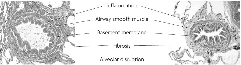 Inflamação das PVA na Asma Hamid, Y. Song, T.C. Kotsimbos, E. Minshall, T.R. Bai and R.G. Hegele et al., Inflammation of small airways in asthma, J Allergy Clin Immunol100(1997), pp.