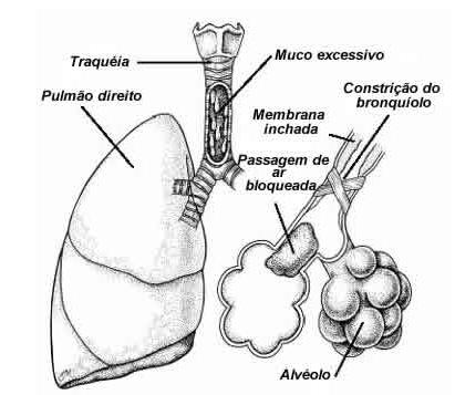 PVA na ASMA nonononononono Pistas clínicas NA PRÁTICA, QUANDO SUSPEITO DE MAIOR ACOMETIMENTO DAS PVA?