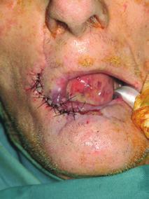Todos os casos apresentaram boa sensibilidade e continência esfincteriana adequada. DISCUSSÃO C Figura 7 Retalho de Webster-ernard. Em, lesão extensa acometendo o lábio inferior.