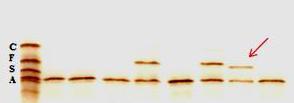 a) b) Pico zona Hb A2 c) d) Figura 3 - Caracterização bioquimica e identificação molecular