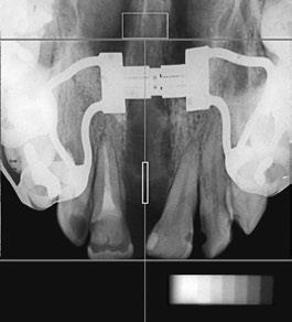2009) C D C) Radiografia oclusal três