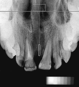 expansor D) Radiografia oclusal seis meses