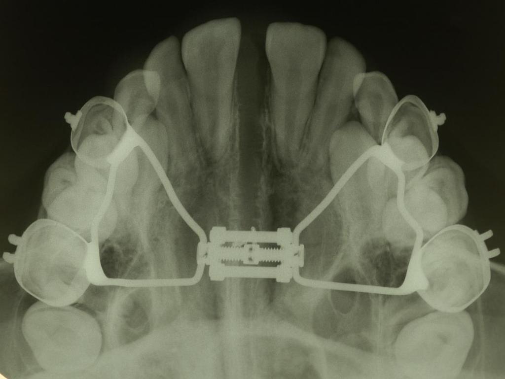 10 dentes e os processos alveolares maxilares excede os limites para a movimentação ortodôntica, ocorre a disjunção maxilar.