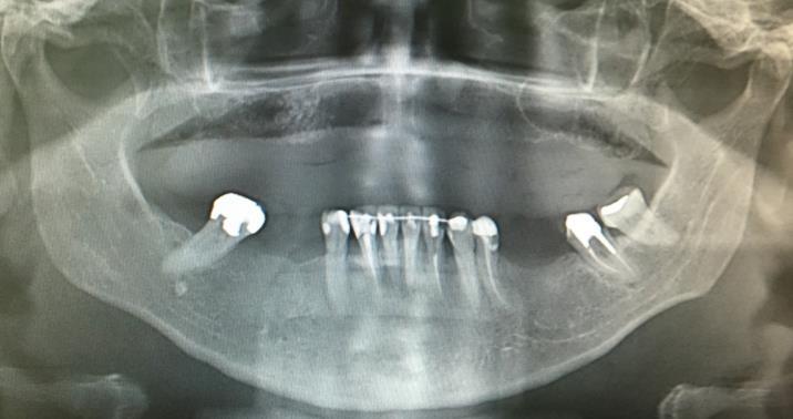 na região anterior e levantamento do seio maxilar esquerdo. Figura 3 Vista oclusal pós-exodontias. Figura 4 Radiografia panorâmica, pós-enxerto e pós-exodontias.