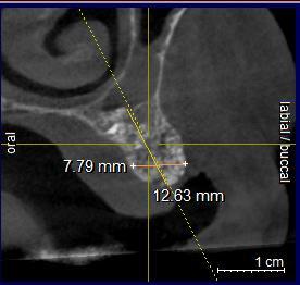 (implante 8) altura de 18,87 mm e espessura vestíbulo-palatina de 11,17mm (Figuras 8G e 8H).