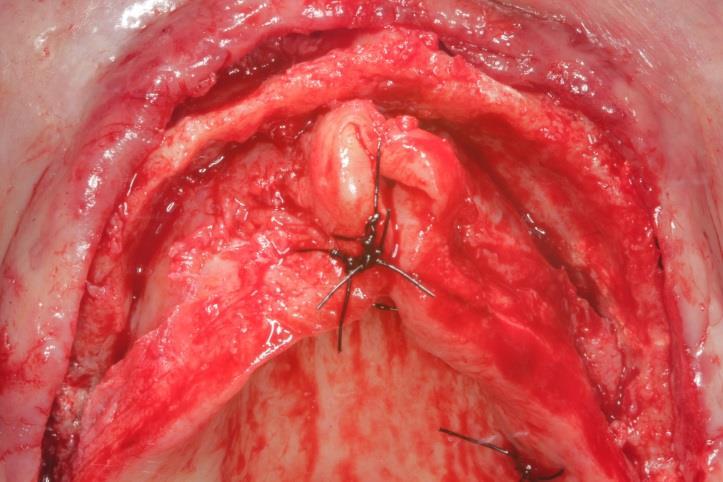 30 A cirurgia de instalação dos implantes do protocolo superior foi realizada com anestesia infiltrativa vestibular e fundo de vestíbulo bilateral em toda a extensão da maxila infraorbitária na