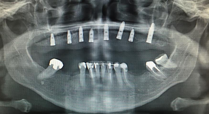Foi realizada radiografia panorâmica pós-operatória imediata (Figura 17). A paciente recebeu instruções quanto à higiene oral e aos cuidados pós-operatórios.