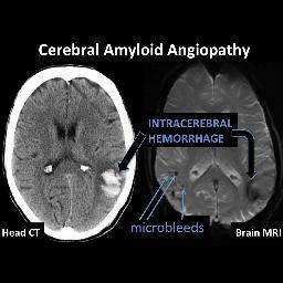 Angiopatia amilóide Acontece devido a deposição de proteína