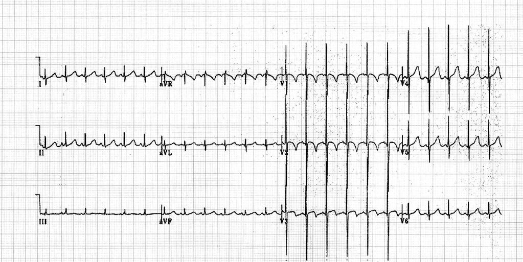 O ECG NORMAL DA