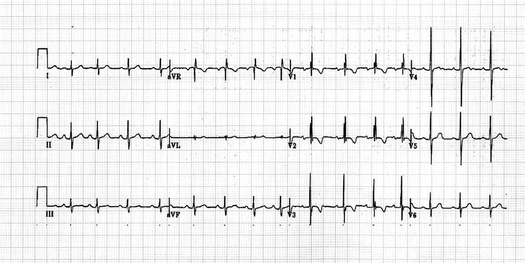 O ECG NORMAL