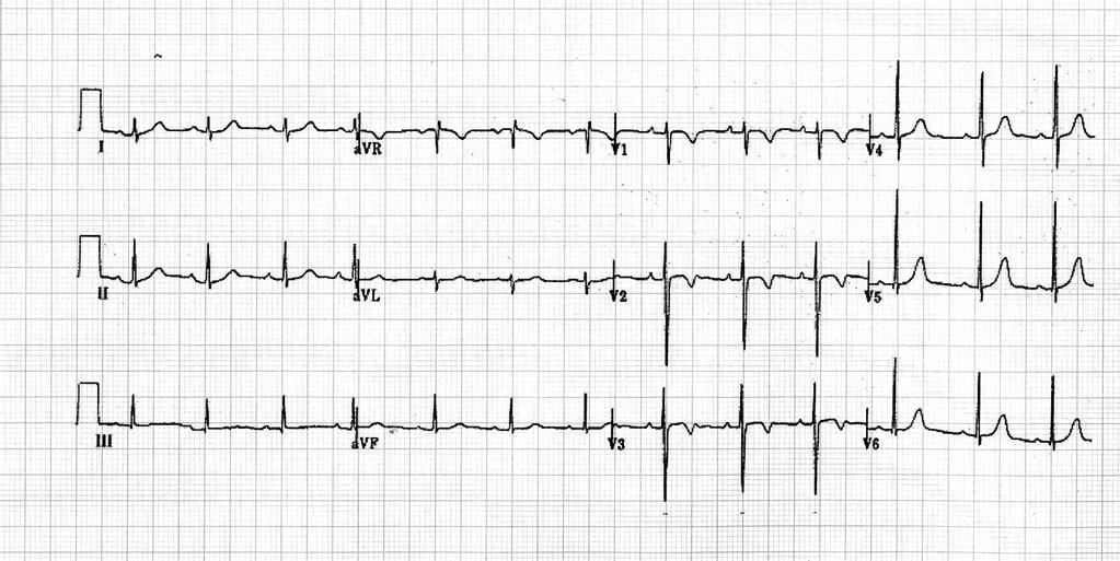 O ECG NORMAL