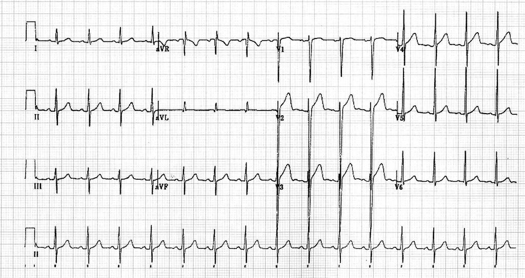 O ECG NORMAL DA