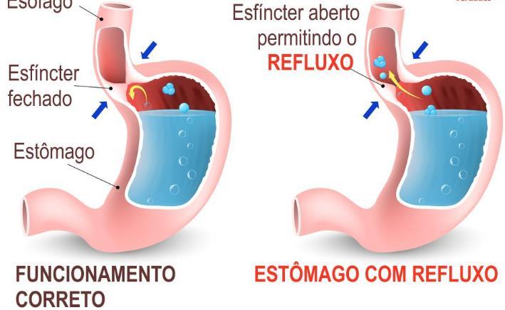 Refluxo e azia mais de duas vezes por semana podem indicar DRGE (doença do refluxo