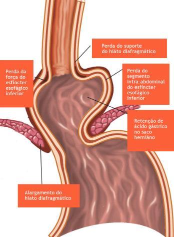 válvula esofágica inferior), medicamentos (ibuprofeno ou relaxantes