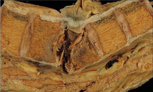 Colapso vertebral