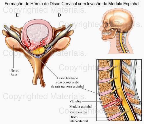 Hernia discal cervical C2 Occiput C4 Shoulder