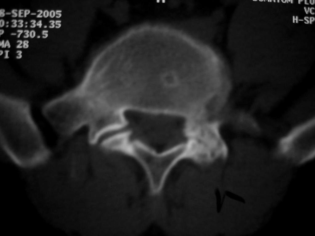 ARTICULAÇÕES INTERAPOFISÁRIAS LOMBALGIA FACETÁRIA ARTROSE