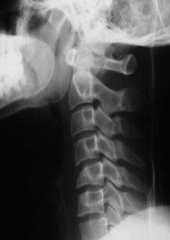 Trauma cervical sem lesão