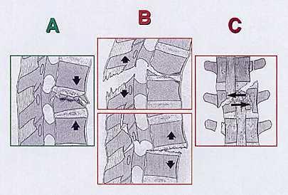 Classificação da AO 1994 Cervical, Torácica e Lombar A: fratura do corpo vertebral por compressão B: