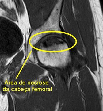 Cabeça Femoral