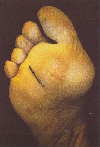 Neuroma de Morton