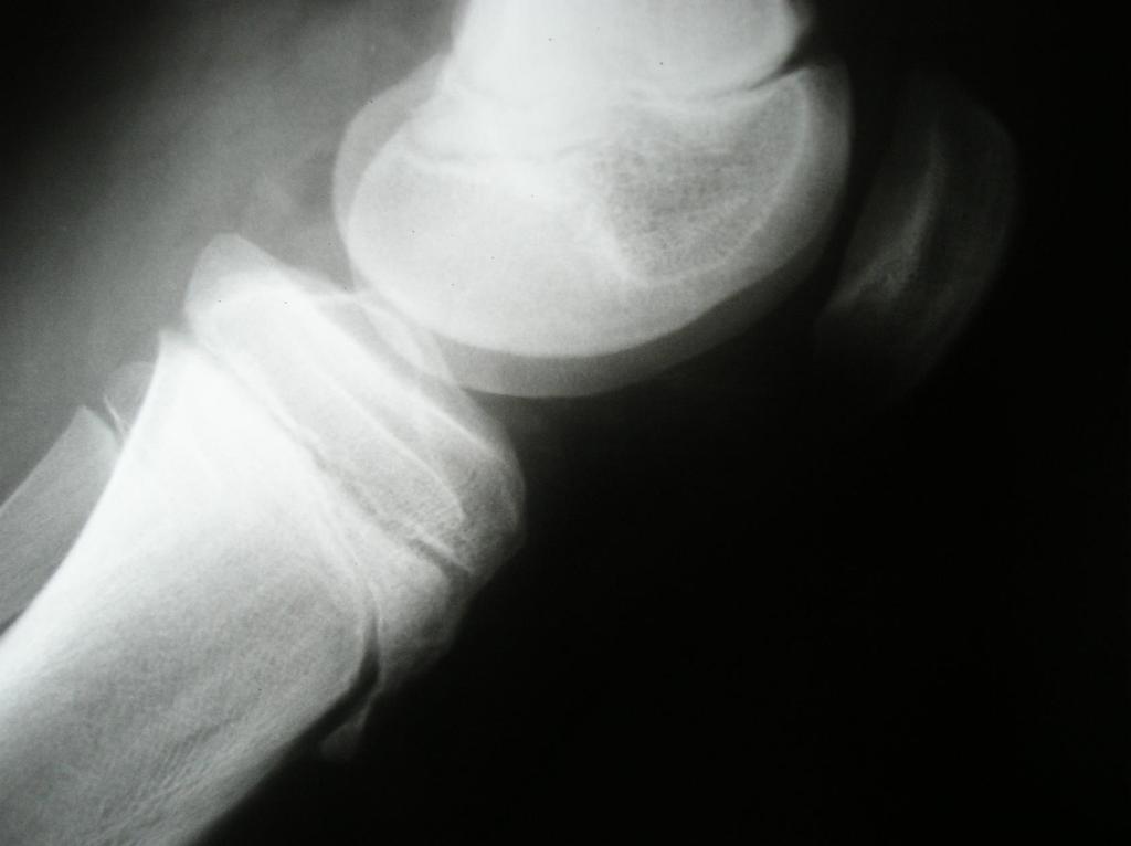 Doença de Osgood-Schlatter Diagnóstico Radiológico: Tuberosidade